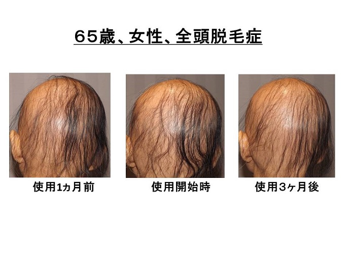 円形脱毛症　名医""